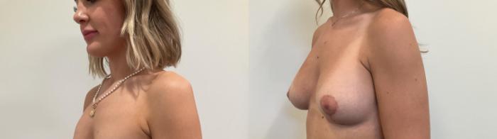 Before & After Breast Lift Case 500 Left Oblique View in Albany, Latham & Saratoga, New York