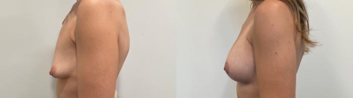 Before & After Breast Lift Case 500 Left Side View in Albany, Latham & Saratoga, New York