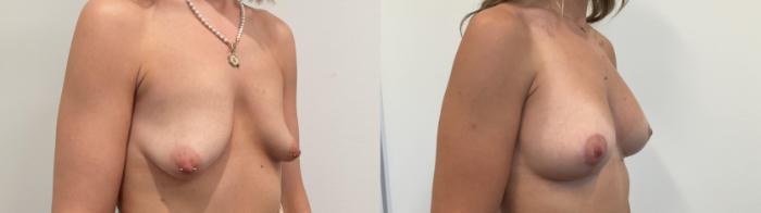 Before & After Breast Lift Case 500 Right Oblique View in Albany, Latham & Saratoga, New York