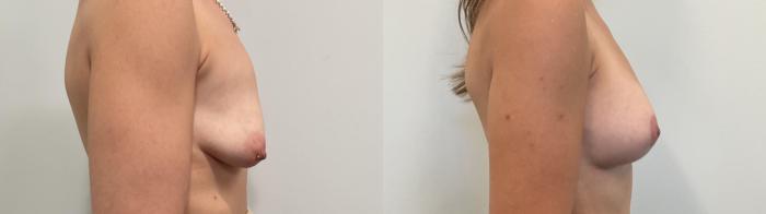 Before & After Breast Lift Case 500 Right Side View in Albany, Latham & Saratoga, New York