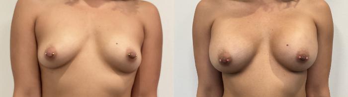 Before & After Breast Augmentation Case 506 Front View in Albany, Latham & Saratoga, New York