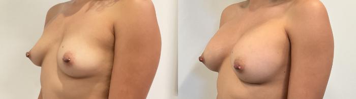 Before & After Breast Augmentation Case 506 Left Oblique View in Albany, Latham & Saratoga, New York