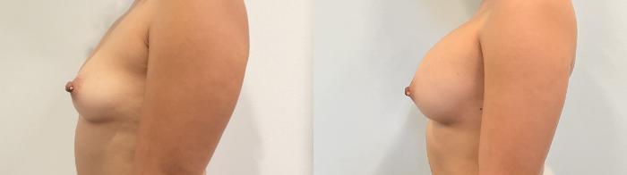 Before & After Breast Augmentation Case 506 Left Side View in Albany, Latham & Saratoga, New York