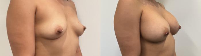 Before & After Breast Augmentation Case 506 Right Oblique View in Albany, Latham & Saratoga, New York