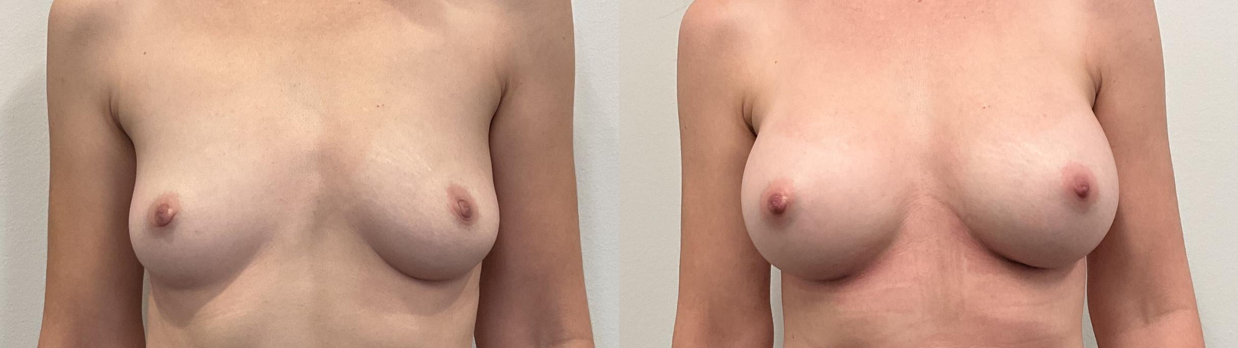 Before & After Breast Augmentation Case 508 Front View in Albany, Latham & Saratoga, New York