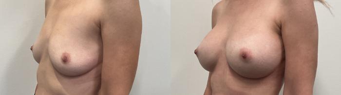 Before & After Breast Augmentation Case 508 Left Oblique View in Albany, Latham & Saratoga, New York