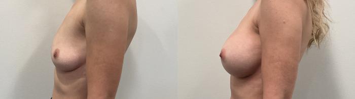 Before & After Breast Augmentation Case 508 Left Side View in Albany, Latham & Saratoga, New York