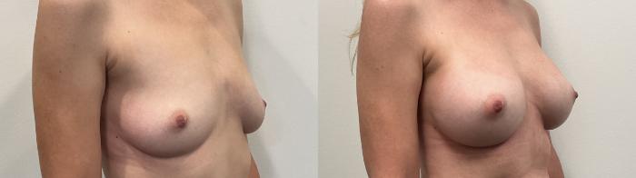 Before & After Breast Augmentation Case 508 Right Oblique View in Albany, Latham & Saratoga, New York