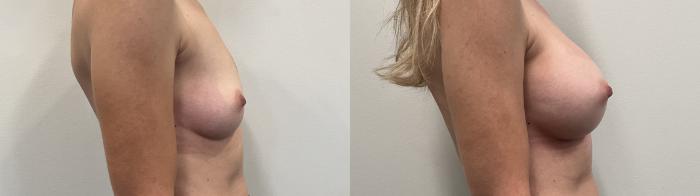Before & After Breast Augmentation Case 508 Right Side View in Albany, Latham & Saratoga, New York