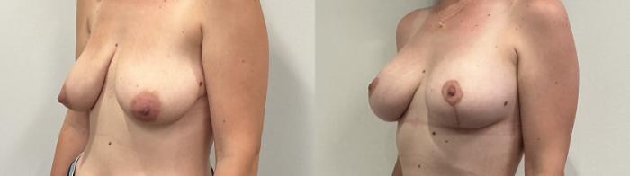Before & After Breast Augmentation Case 511 Left Oblique View in Albany, Latham & Saratoga, New York