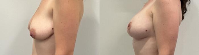 Before & After Breast Augmentation Case 511 Left Side View in Albany, Latham & Saratoga, New York
