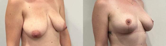 Before & After Breast Augmentation Case 511 Right Oblique View in Albany, Latham & Saratoga, New York