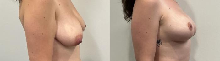 Before & After Breast Augmentation Case 511 Right Side View in Albany, Latham & Saratoga, New York