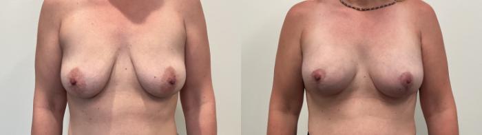 Before & After Breast Augmentation Case 516 Front View in Albany, Latham & Saratoga, New York