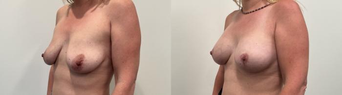 Before & After Breast Augmentation Case 516 Left Oblique View in Albany, Latham & Saratoga, New York