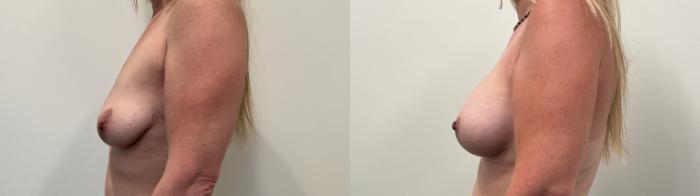 Before & After Breast Augmentation Case 516 Left Side View in Albany, Latham & Saratoga, New York
