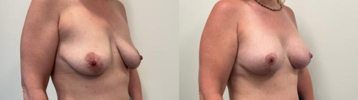 Before & After Breast Augmentation Case 516 Right Oblique View in Albany, Latham & Saratoga, New York