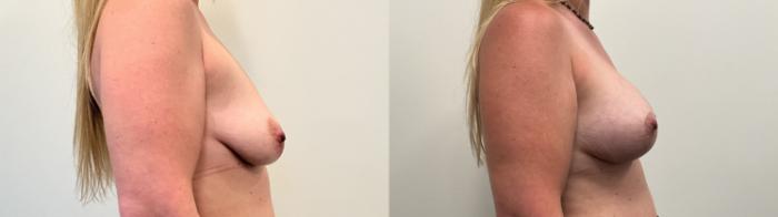Before & After Breast Augmentation Case 516 Right Side View in Albany, Latham & Saratoga, New York