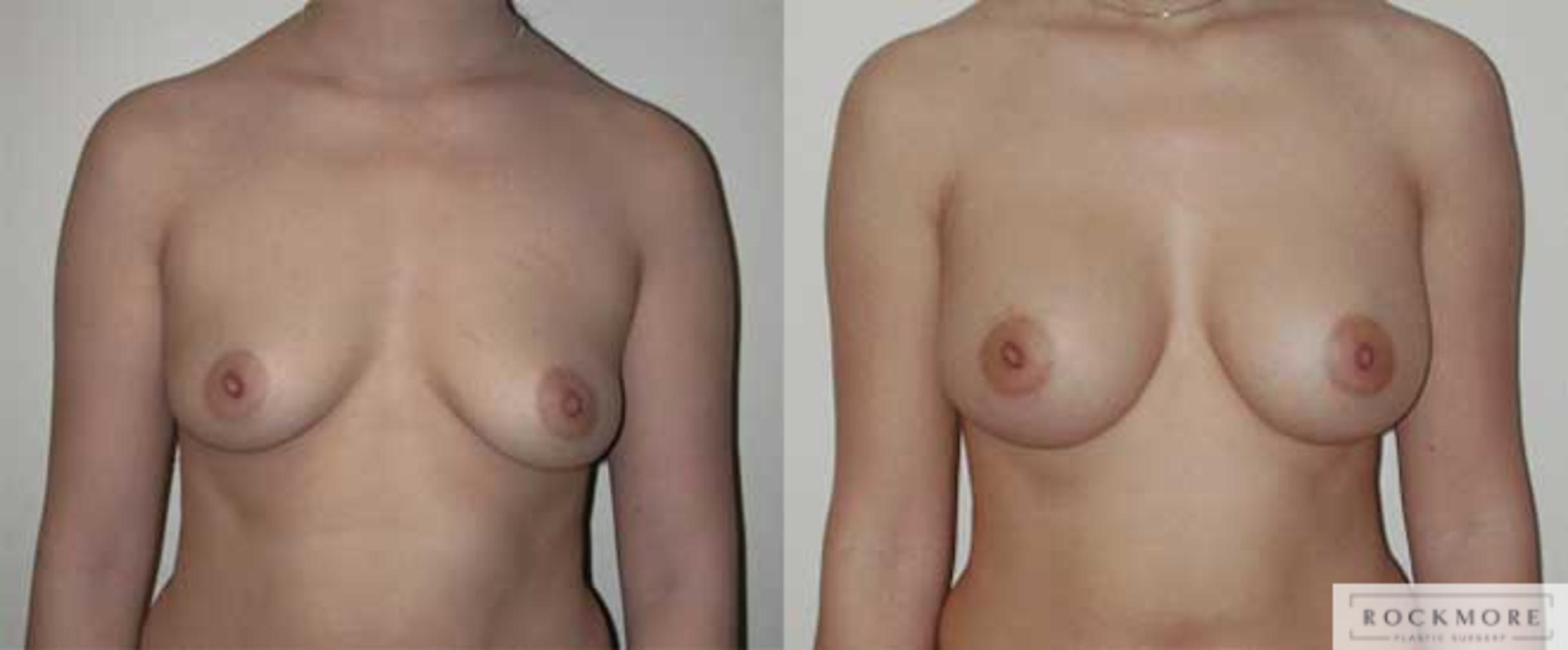 Before & After Breast Augmentation Case 6 View #1 View in Albany & Latham, New York