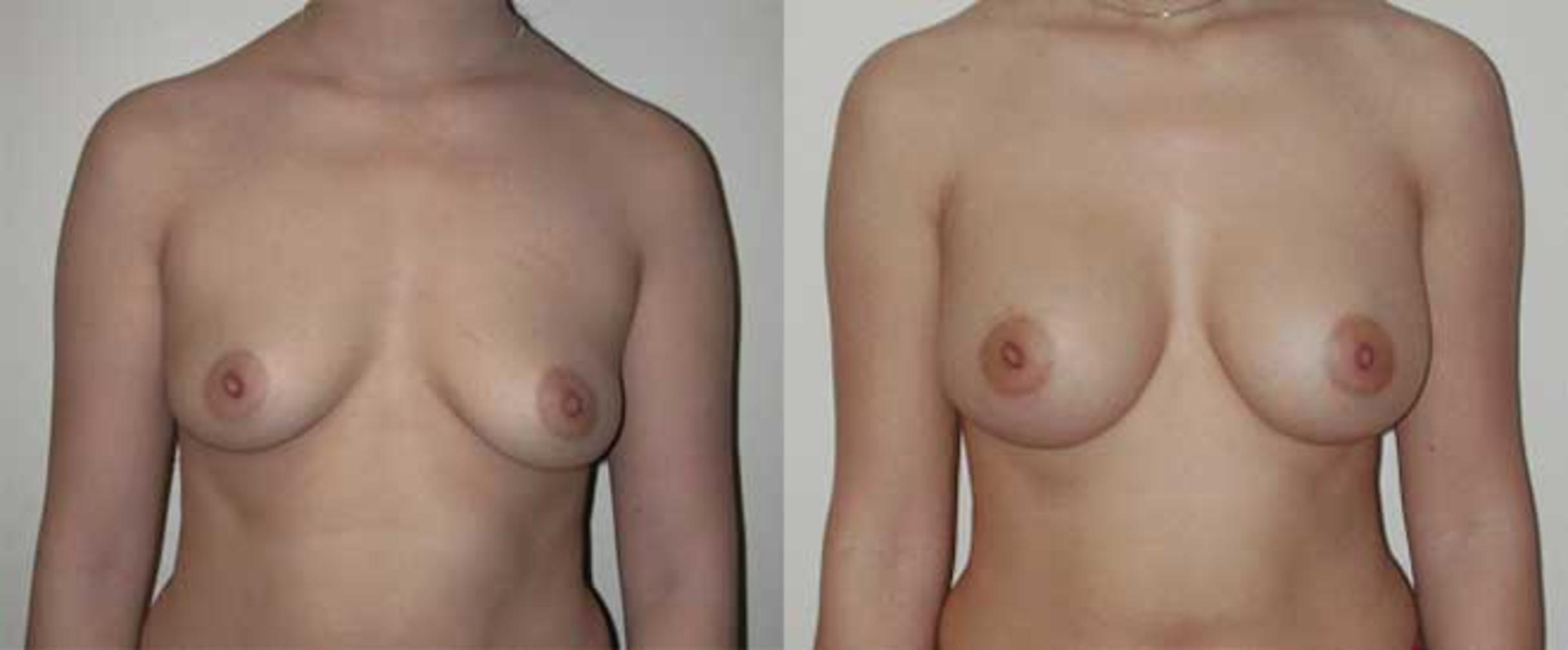 Before & After Breast Augmentation Case 6 View #1 View in Albany, Latham & Saratoga, New York