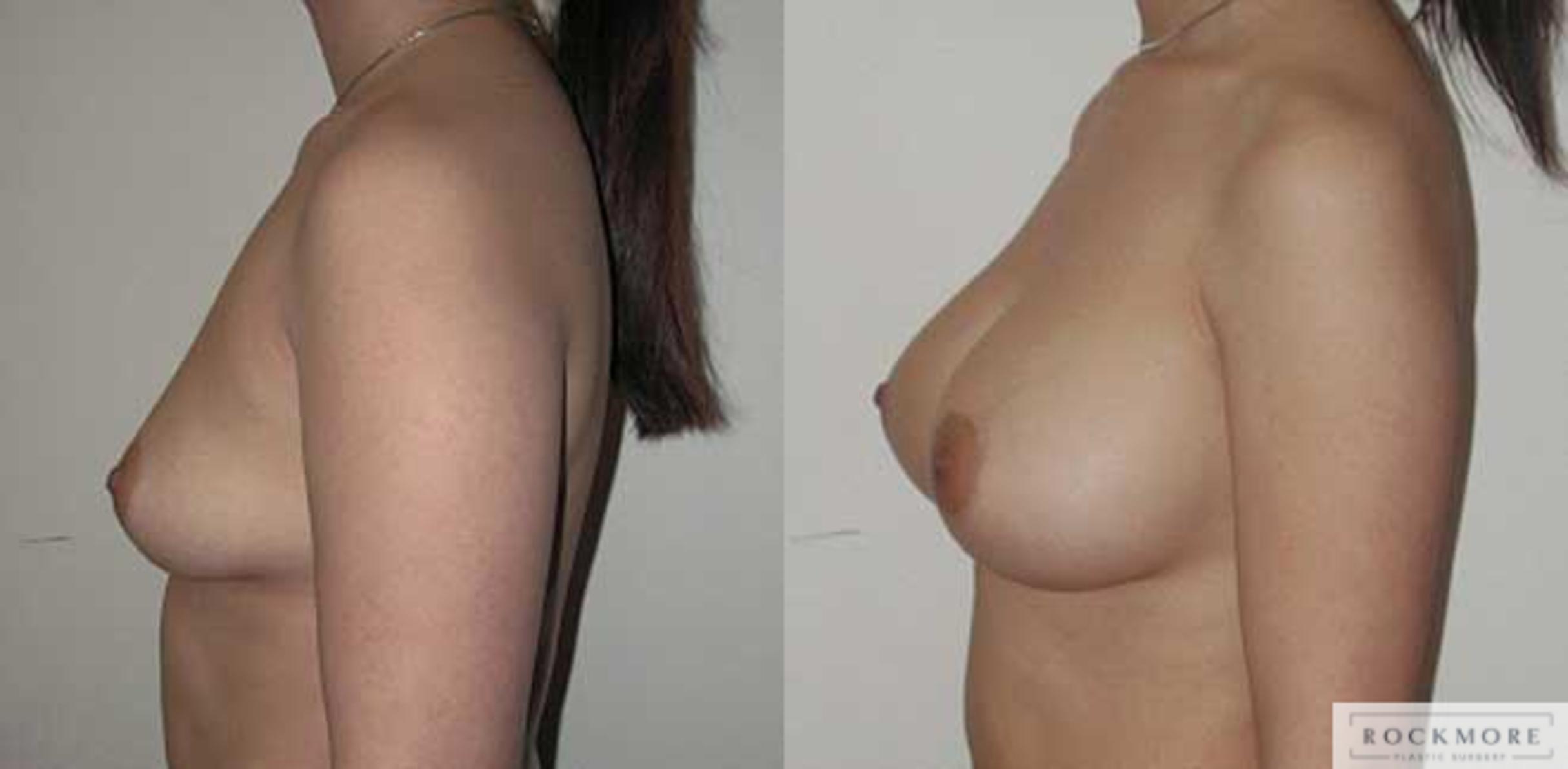 Before & After Breast Augmentation Case 6 View #2 View in Albany & Latham, New York