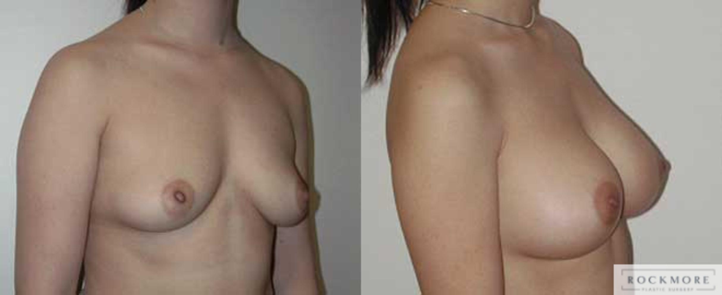 Before & After Breast Augmentation Case 6 View #3 View in Albany & Latham, New York