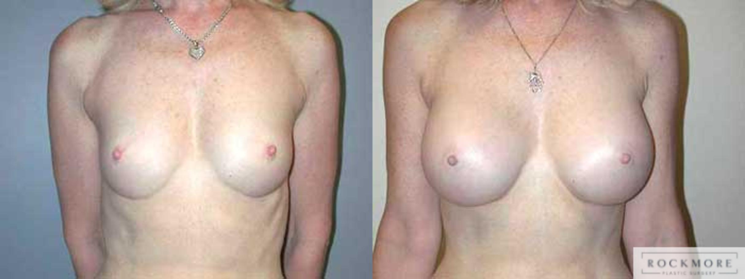 Before & After Breast Augmentation Case 7 View #1 View in Albany & Latham, New York