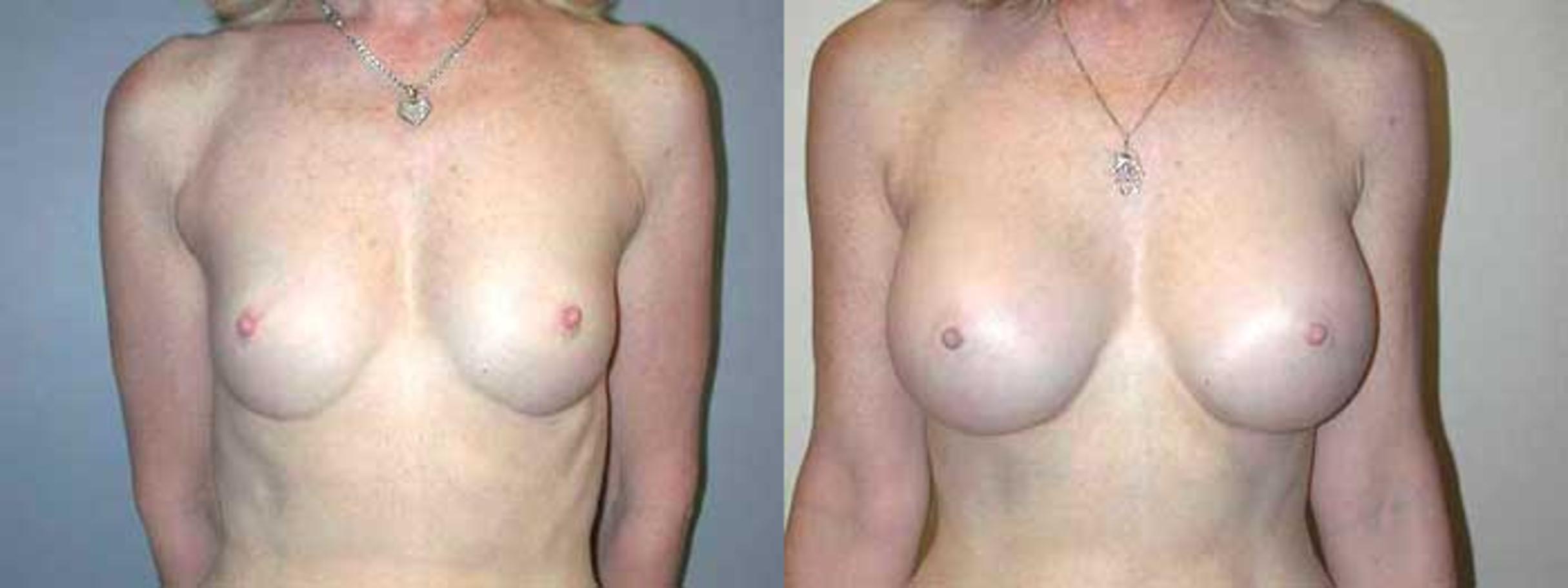 Before & After Breast Augmentation Case 7 View #1 View in Albany & Latham, New York