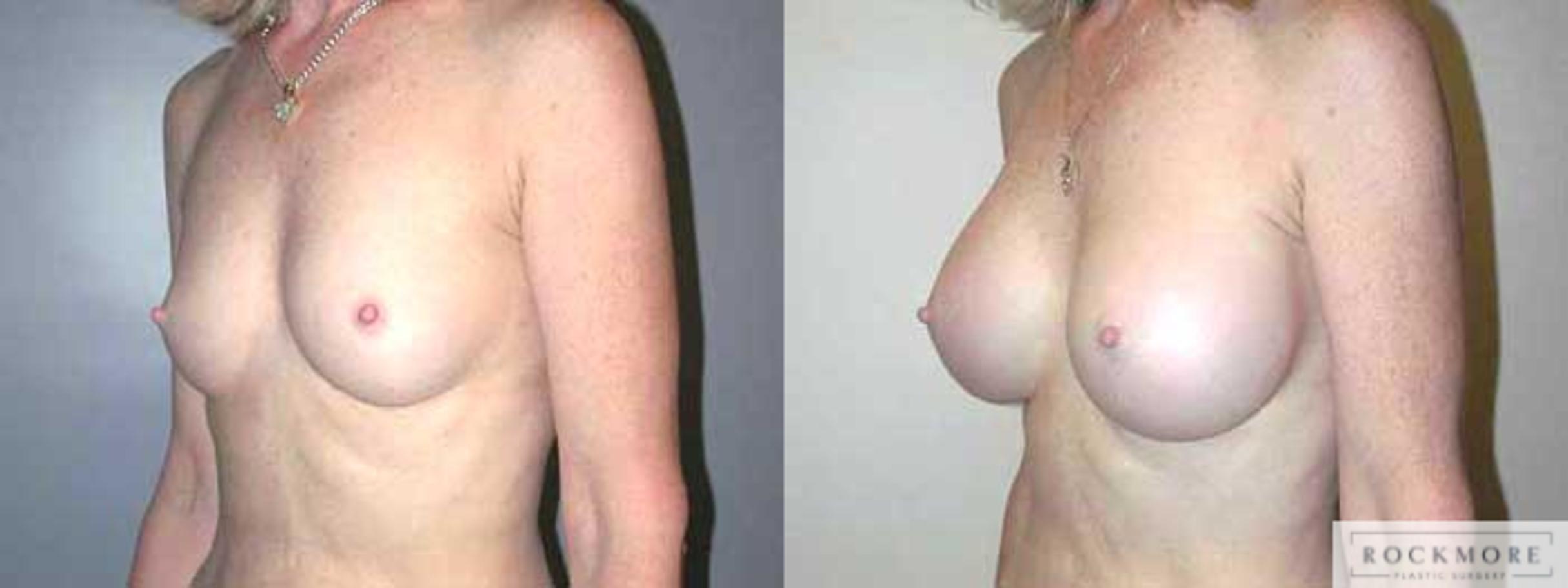 Before & After Breast Augmentation Case 7 View #2 View in Albany & Latham, New York