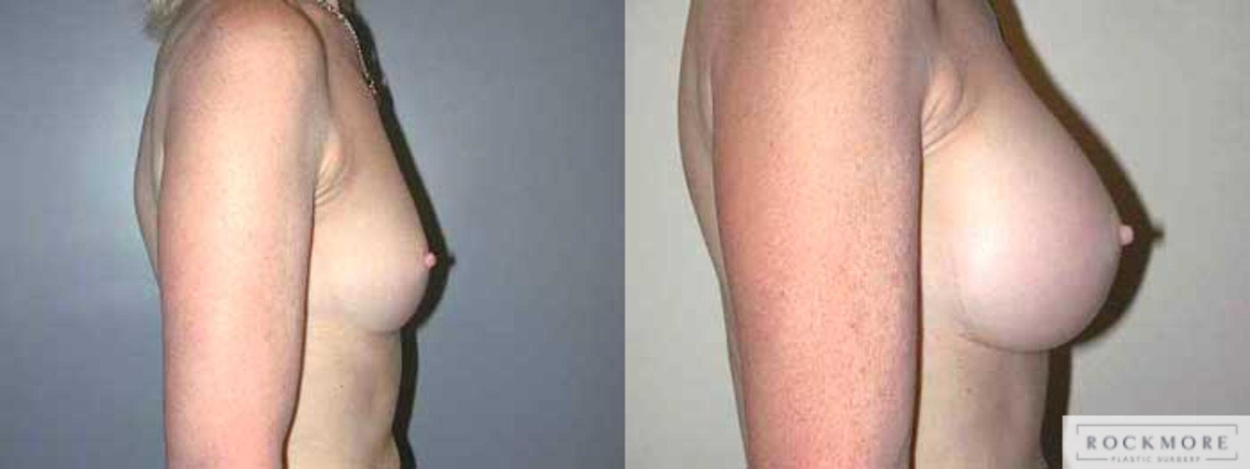 Before & After Breast Augmentation Case 7 View #3 View in Albany & Latham, New York
