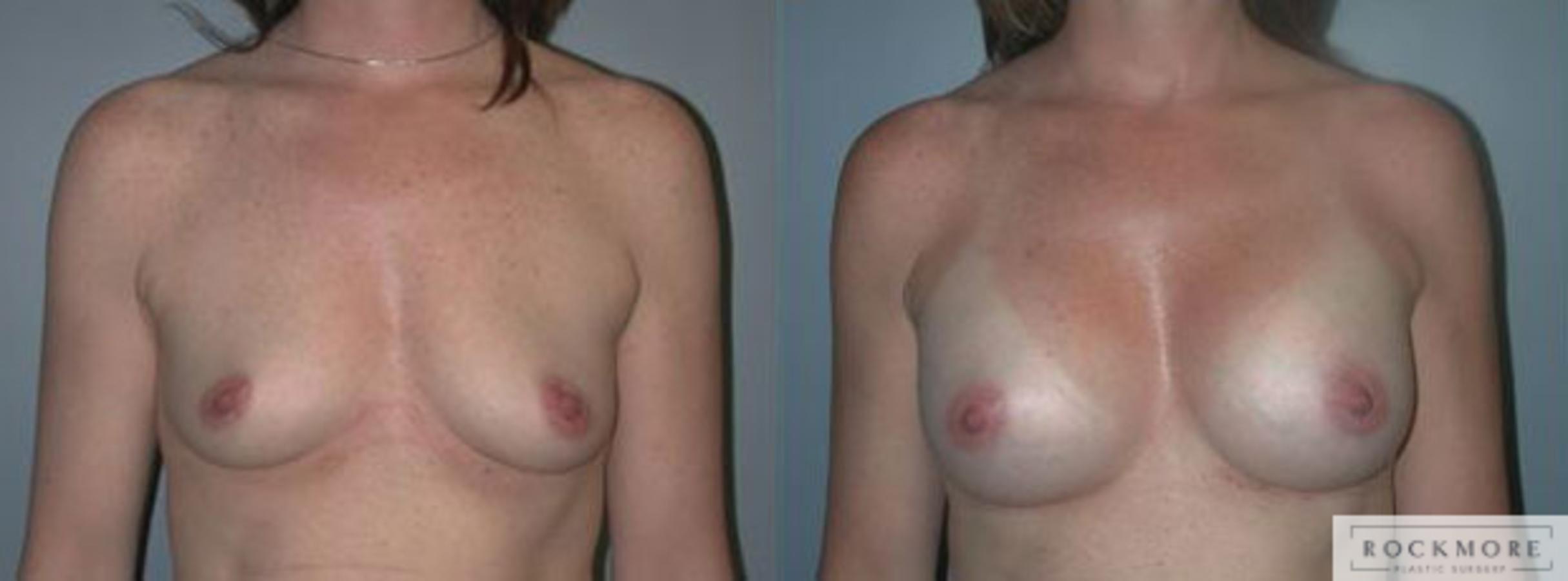 Before & After Breast Augmentation Case 90 View #1 View in Albany & Latham, New York