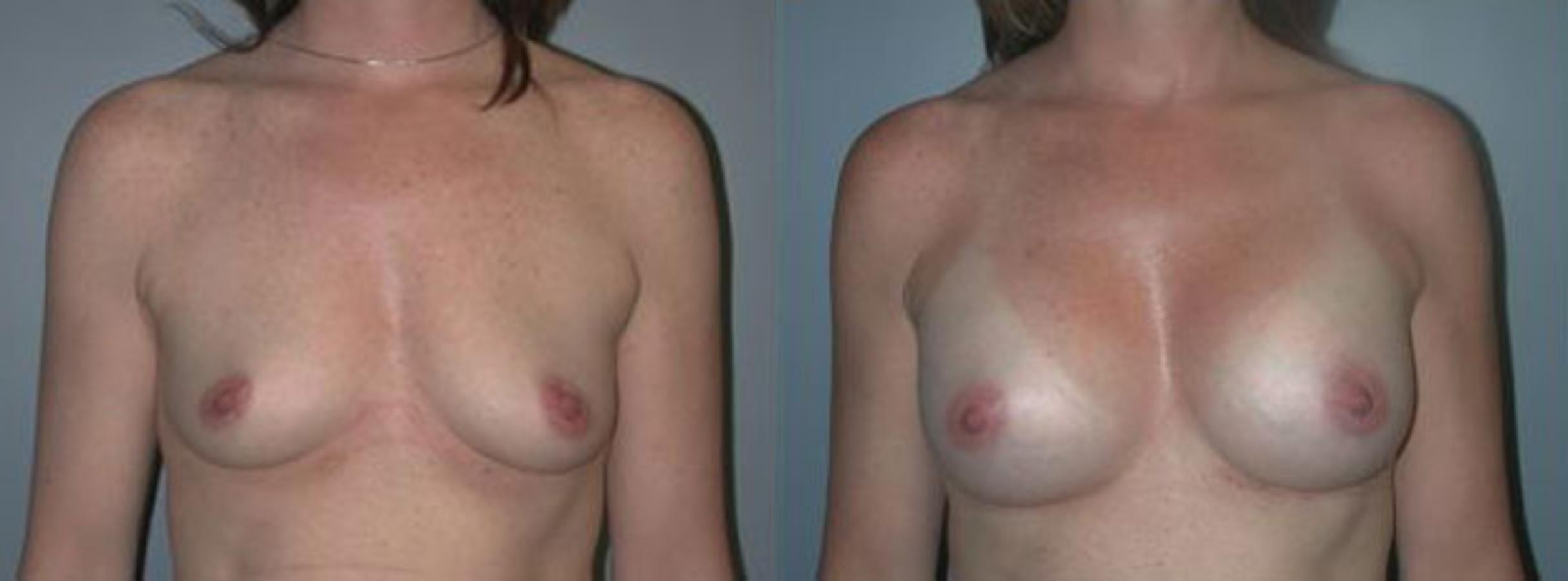 Before & After Breast Augmentation Case 90 View #1 View in Albany & Latham, New York