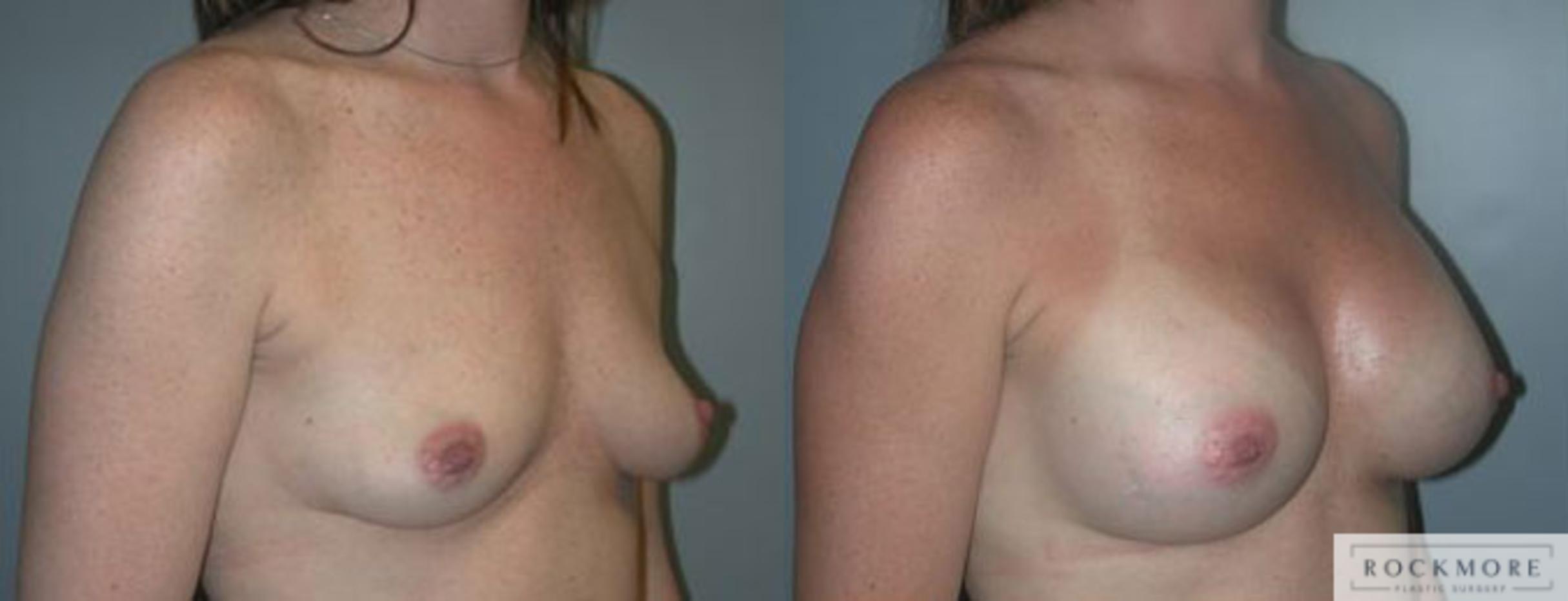 Before & After Breast Augmentation Case 90 View #2 View in Albany & Latham, New York