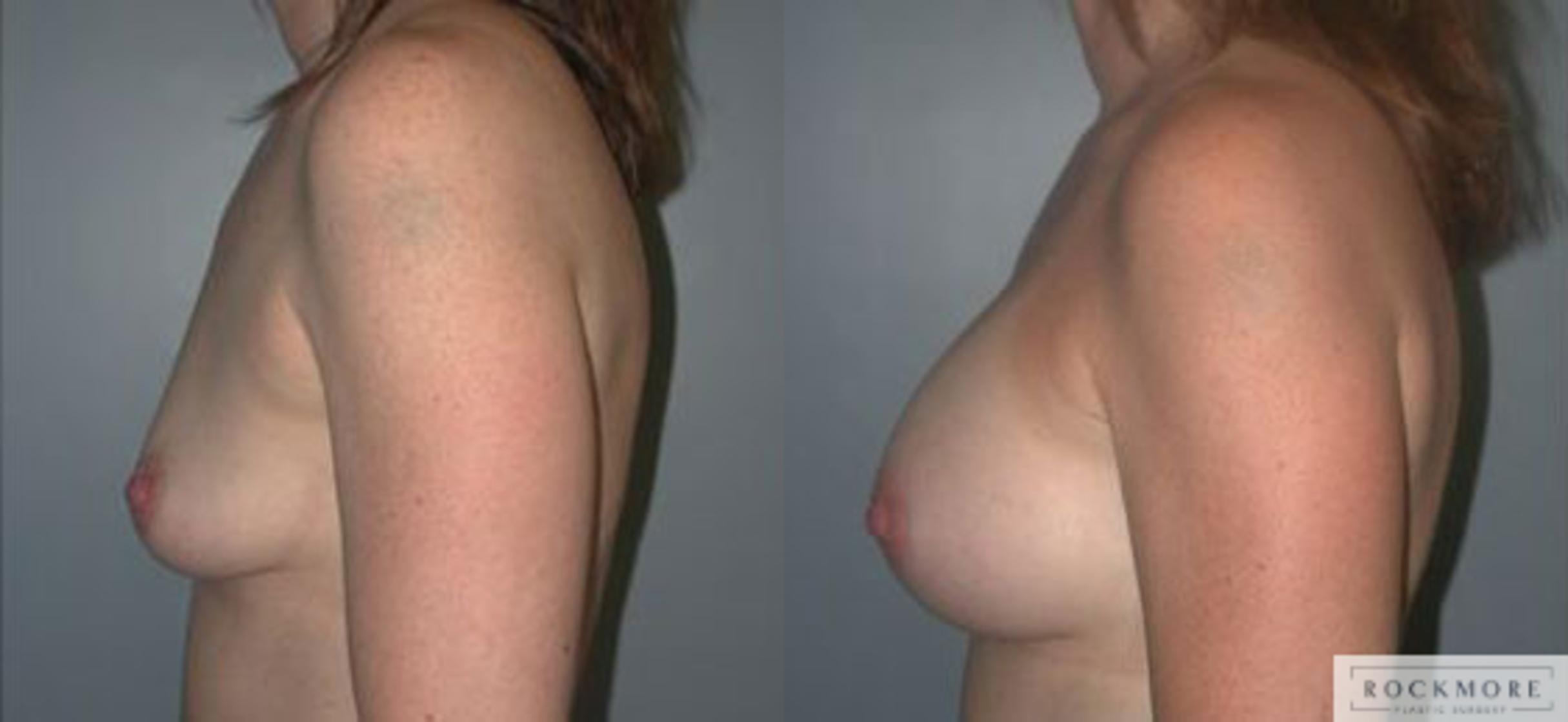 Before & After Breast Augmentation Case 90 View #3 View in Albany & Latham, New York