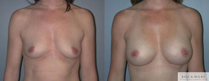 Before & After Breast Augmentation Case 98 View #1 View in Albany & Latham, New York