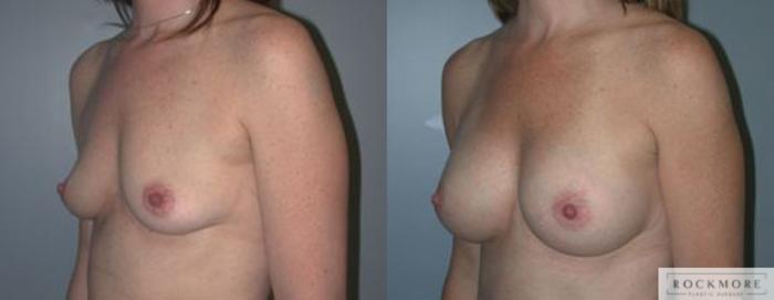 Before & After Breast Augmentation Case 98 View #2 View in Albany & Latham, New York