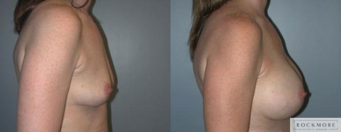 Before & After Breast Augmentation Case 98 View #3 View in Albany & Latham, New York