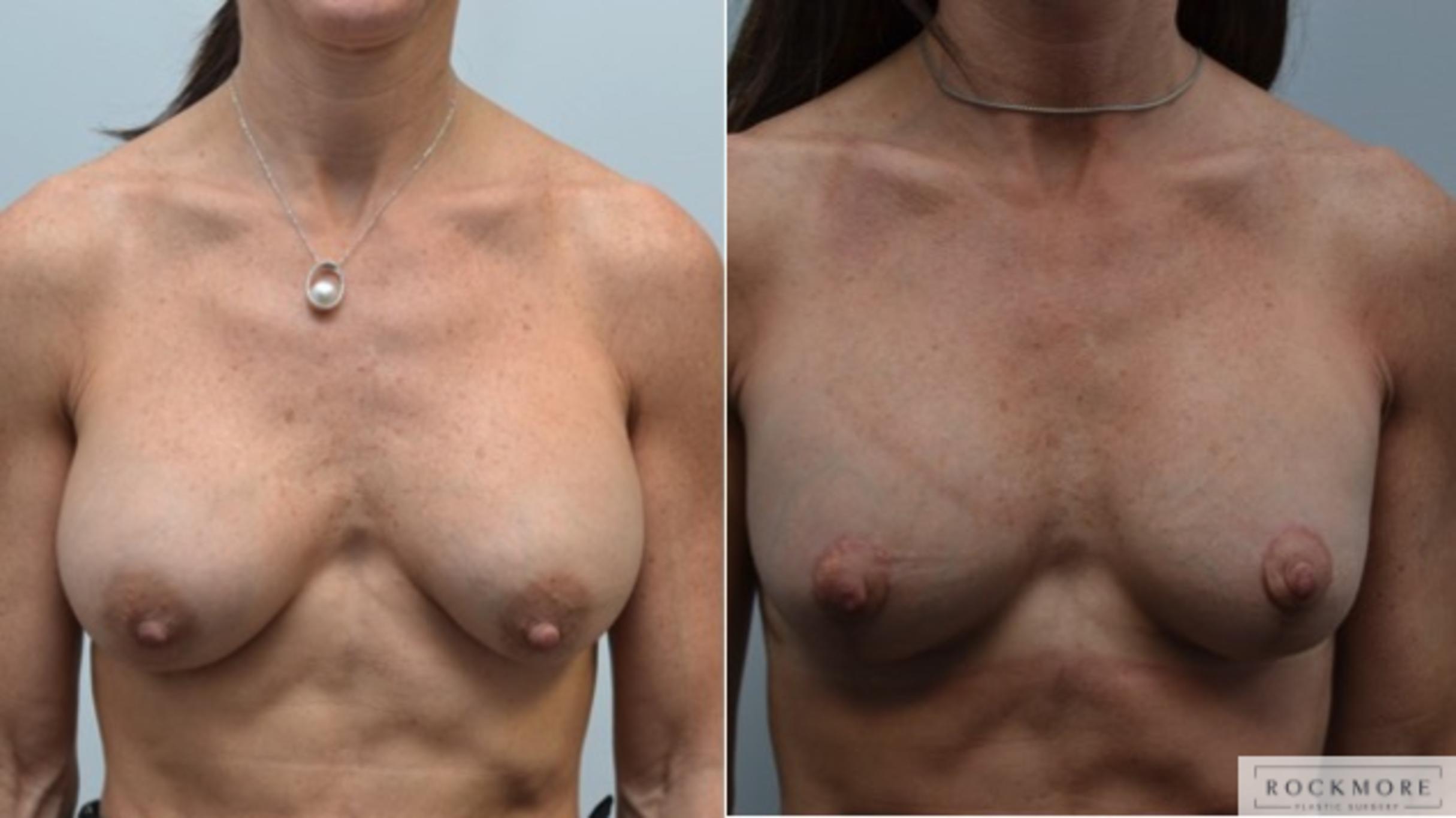 Before & After Breast Lift Case 251 View #1 View in Albany & Latham, New York