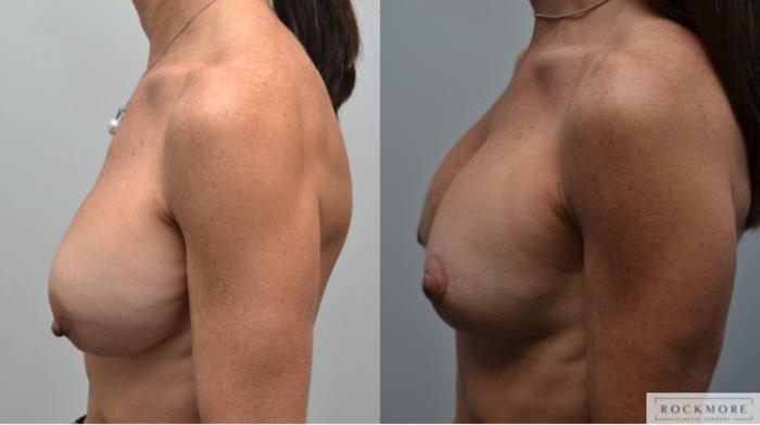 Before & After Breast Augmentation Revision Case 251 View #2 View in Albany & Latham, New York