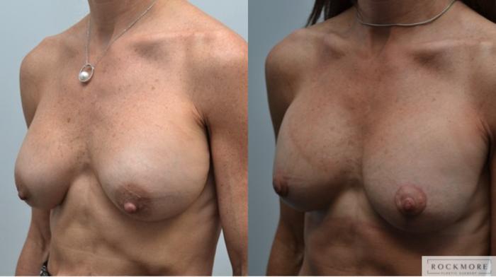 Before & After Breast Augmentation Revision Case 251 View #3 View in Albany & Latham, New York