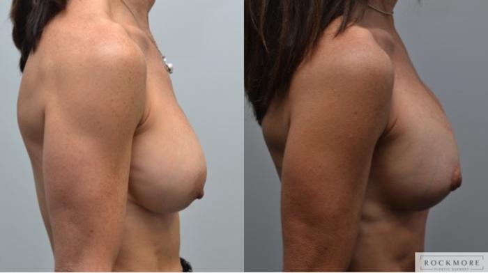 Before & After Breast Augmentation Revision Case 251 View #4 View in Albany & Latham, New York