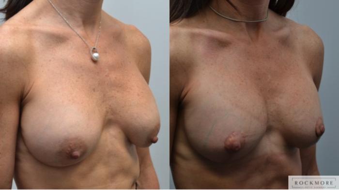 Before & After Breast Augmentation Revision Case 251 View #5 View in Albany & Latham, New York