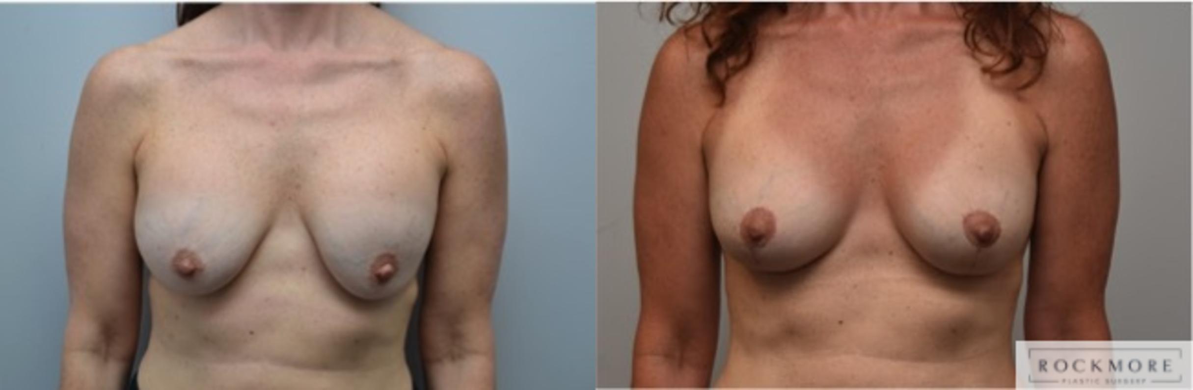 Before & After Breast Augmentation Revision Case 291 View #1 View in Albany & Latham, New York