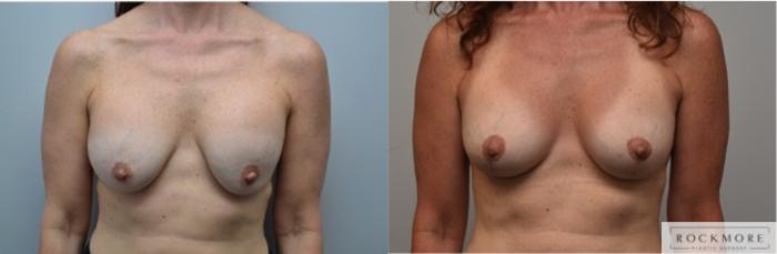 Before & After Breast Augmentation Revision Case 291 View #1 View in Albany & Latham, New York