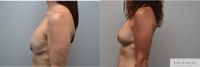 Before & After Breast Augmentation Revision Case 291 View #2 View in Albany & Latham, New York