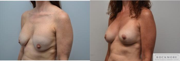 Before & After Breast Augmentation Revision Case 291 View #3 View in Albany & Latham, New York