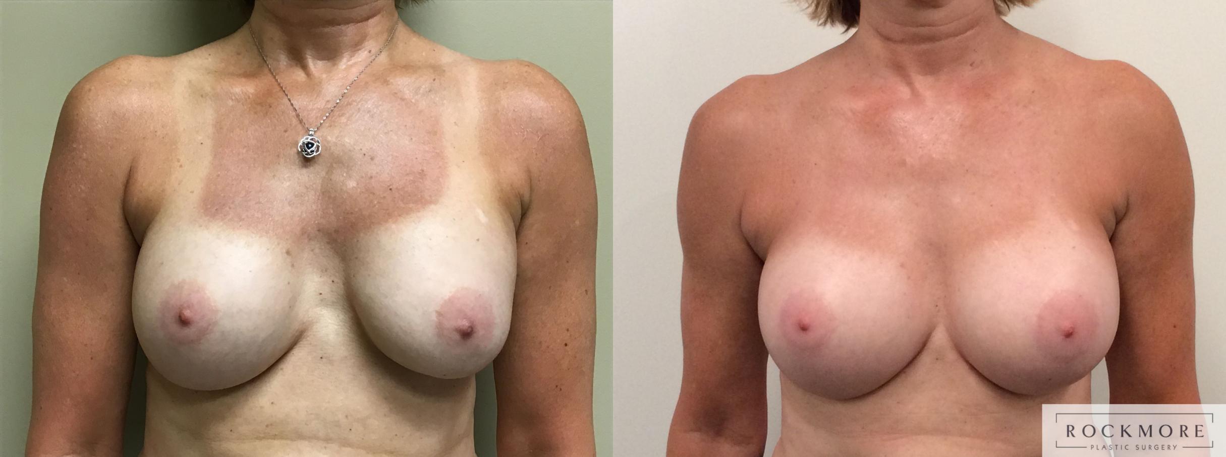 Before & After Breast Augmentation Revision Case 381 Front View in Albany & Latham, New York