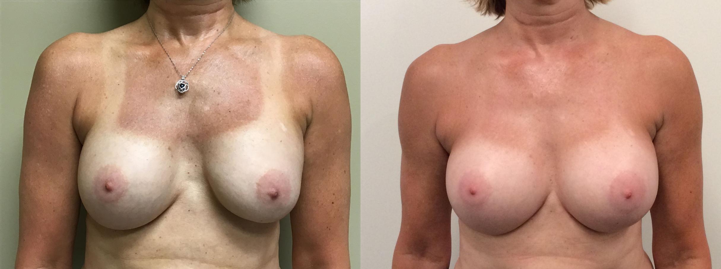 Before & After Breast Augmentation Revision Case 381 Front View in Albany & Latham, New York