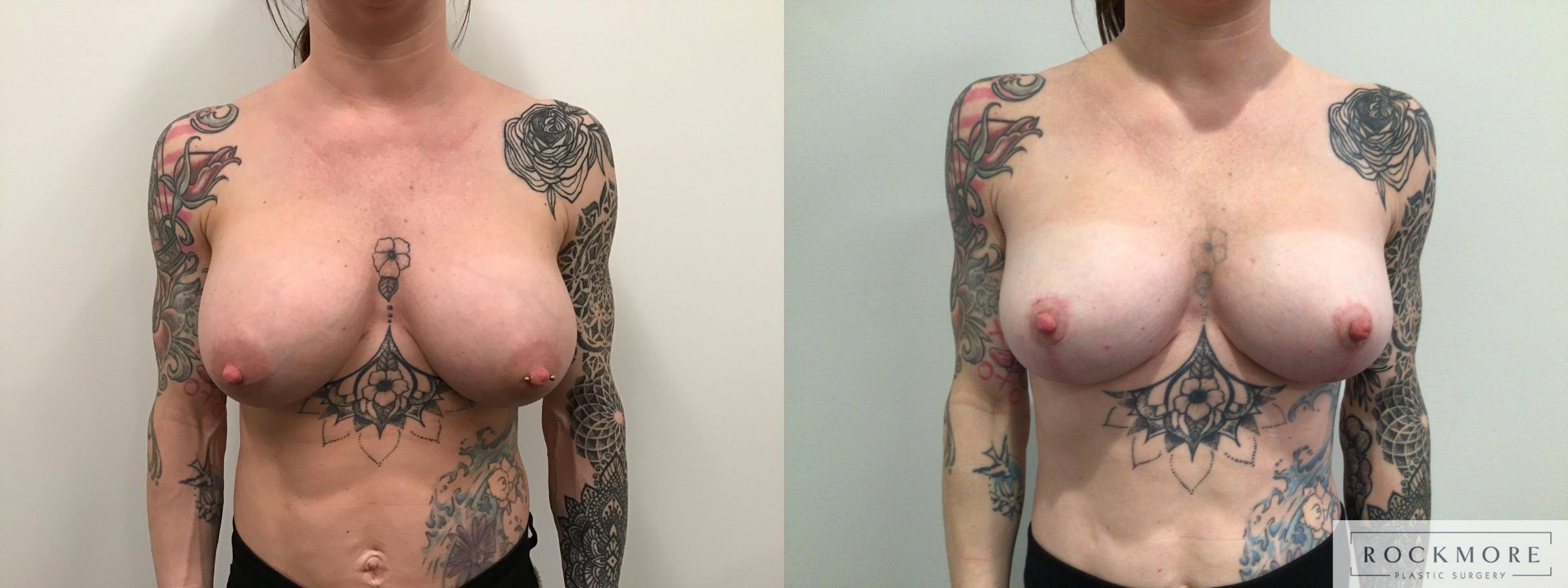 Before & After Breast Augmentation Revision Case 436 Front View in Albany & Latham, New York
