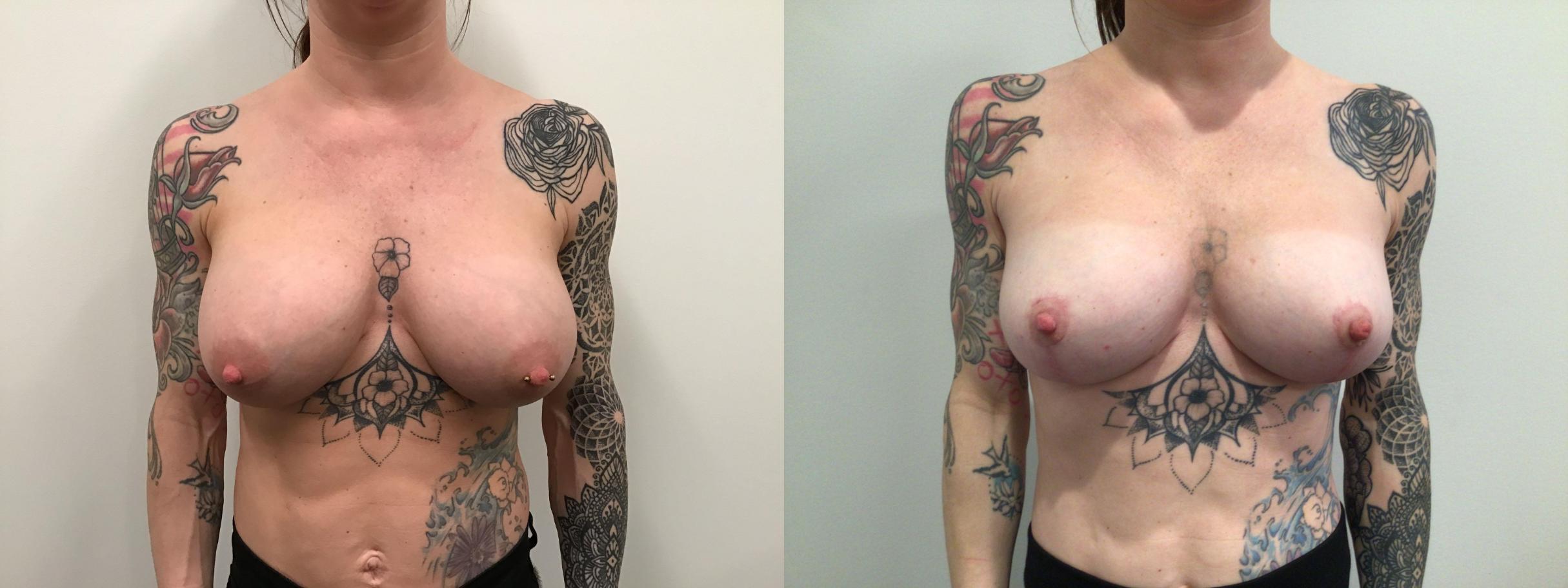 Before & After Breast Augmentation Revision Case 436 Front View in Albany & Latham, New York